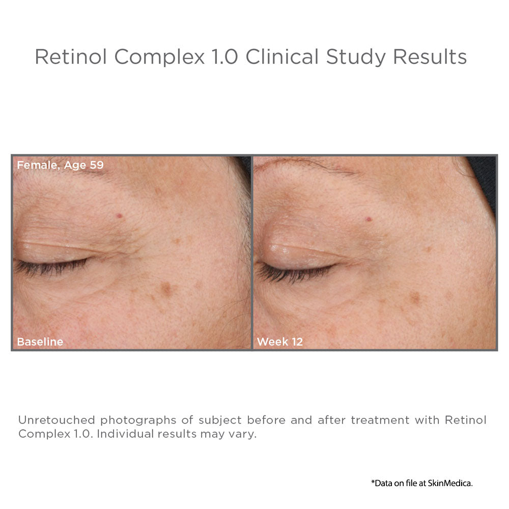 SkinMedica Retinol Complex results 2