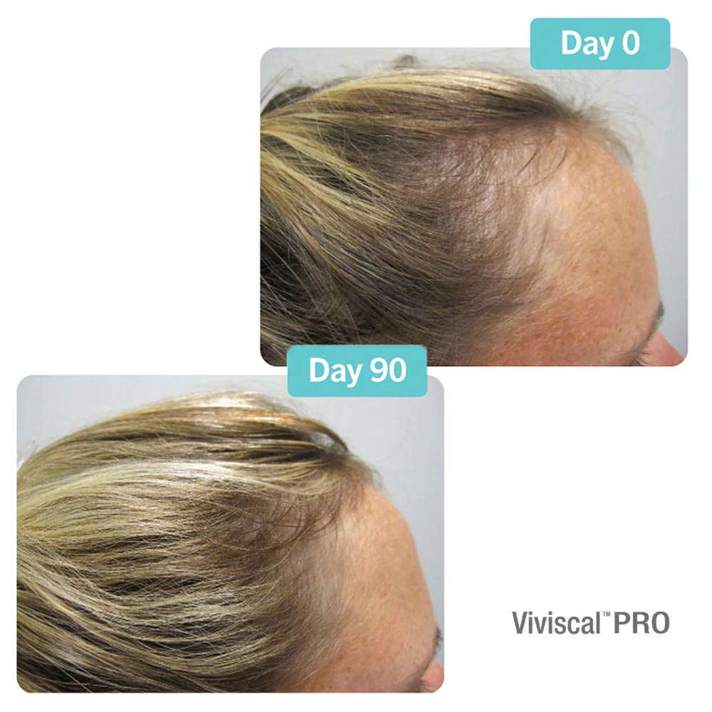 Viviscal Pro Hair Supplements 90 days results
