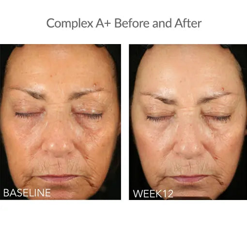Before and after results after using ZO Complex A Retinol