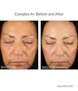 Before and after results after using ZO Complex A Retinol