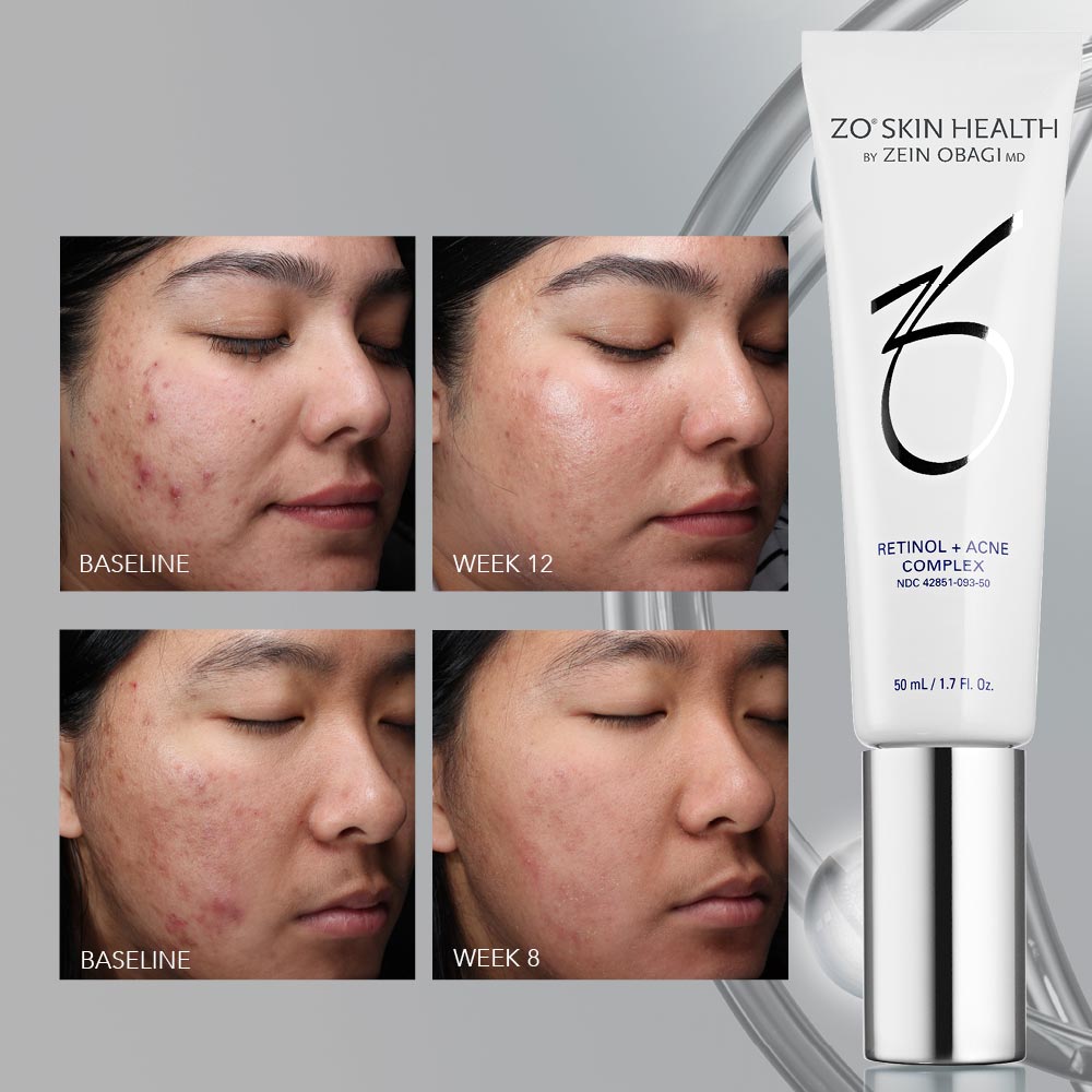 ZO Skin Health Retinol + Acne Complex results